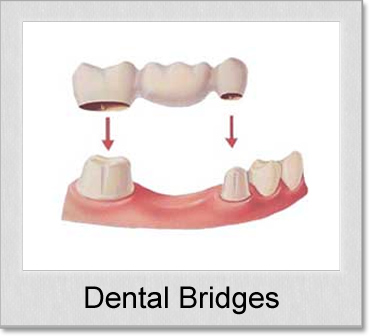 dental bridge matthews